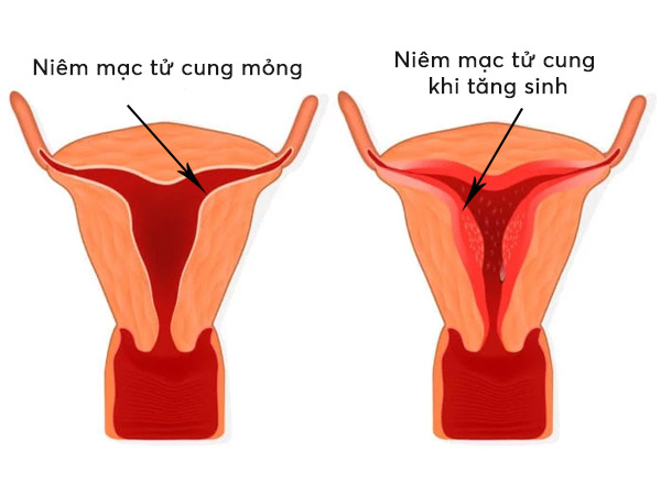 Tái tạo niêm mạc tử cung với OvaQ1