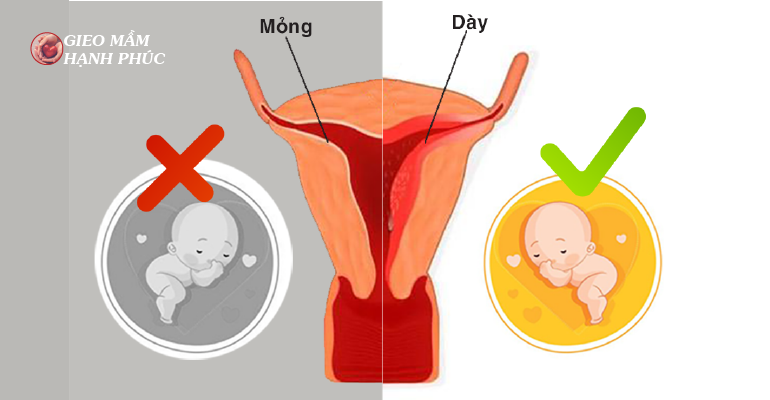 NIÊM MẠC TỬ CUNG MỎNG ẢNH HƯỞNG ĐẾN VIỆC CÓ BÉ NHƯ THẾ NÀO? - Nhà ...